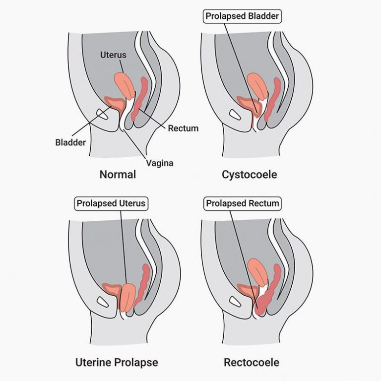 Pelvic Organ Prolapse | Donna Sarna
